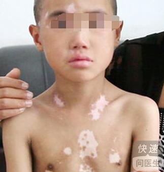 小孩白癜风可以根治吗